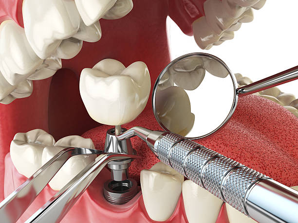 Best Emergency Tooth Extraction in Imlay City, MI